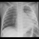 verdict - Pneumonie